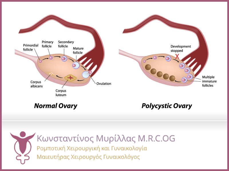 Πολυκυστικές Ωοθήκες, Μέθοδοι Θεραπείας και Συμβουλές