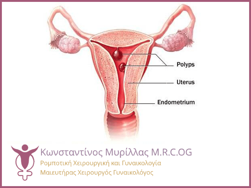 Πολύποδας μήτρας, θεραπεία και τεχνικές αφαίρεσης