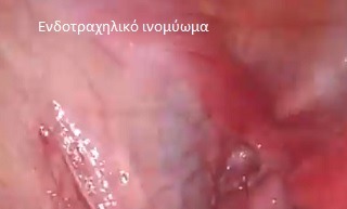 Ενδοτραχηλικό ινομύωμα (σπάνια μορφή)