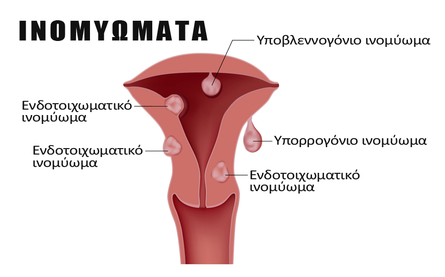 Ινομυώματα Μήτρας: Τι Είναι – Αίτια – Εγκυμοσύνη: Iνομυώματα Mήτρας – Τι Eίναι