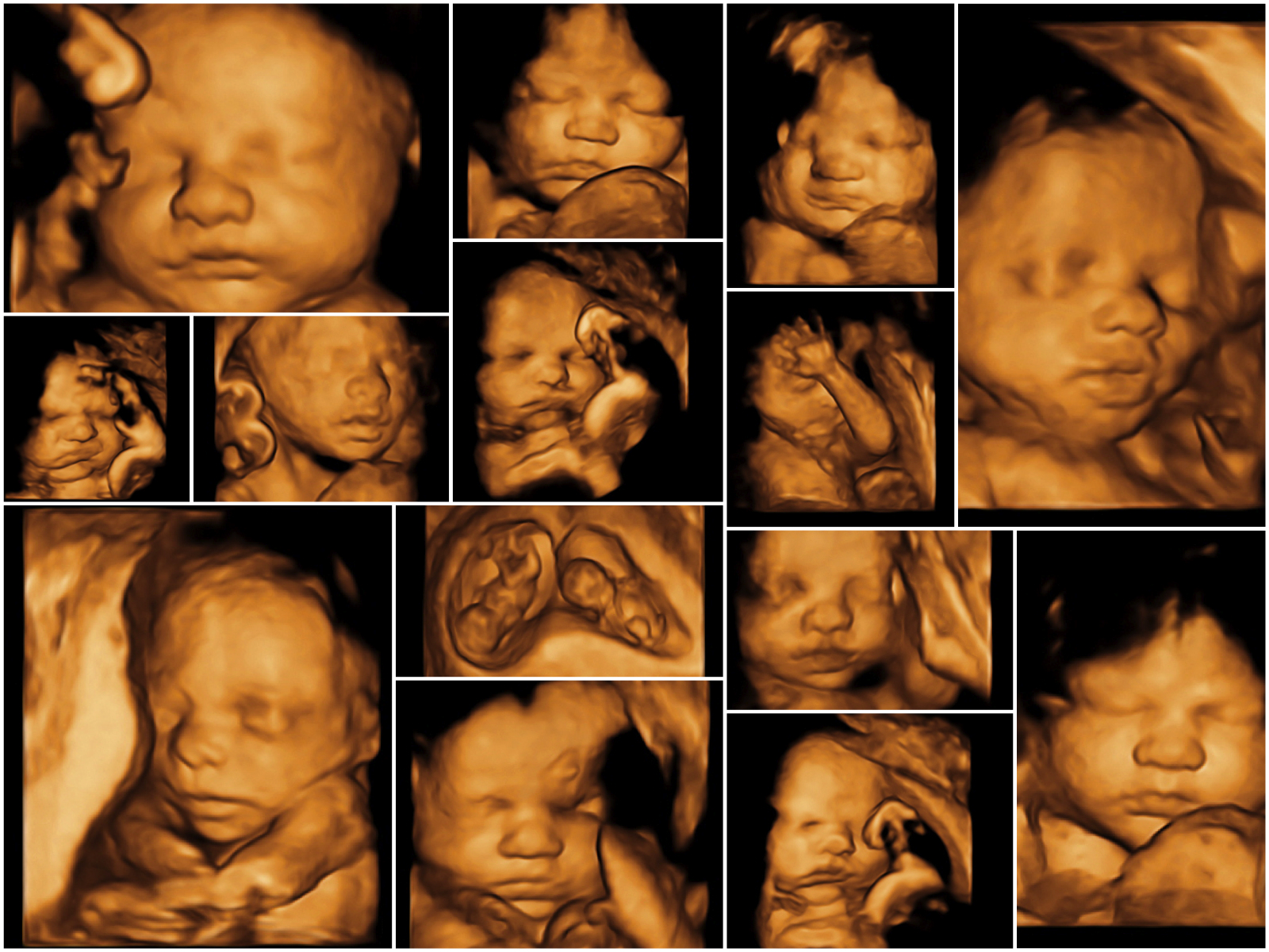 4D imaging (real time 3D)