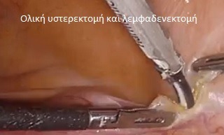 Ολική υστερεκτομή και λεμφαδενεκτομή λόγω καρκίνου στο ενδομήτριο