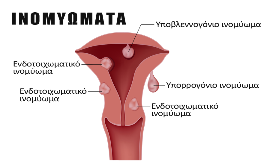 Ινομυώματα Μήτρας: Τι Είναι – Αίτια – Εγκυμοσύνη